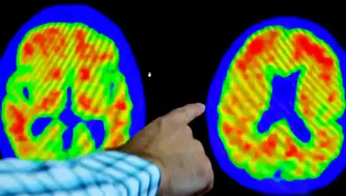 Uçuk Virüsü ile Alzheimer Bağlantısı: Yeni Araştırma