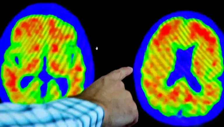Uçuk Virüsü ile Alzheimer Bağlantısı: Yeni Araştırma